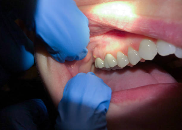 Best Emergency Dental Extractions in Seabrook, MD